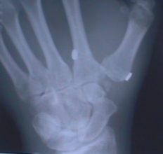 X-Ray After Tight Rope Suspension Surgery