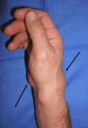 A wrist where large bumps are being shown with arrows