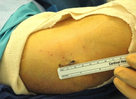 An incision made into the cubital of an arm measuring two inches