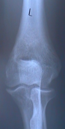 An xray of a normal elbow