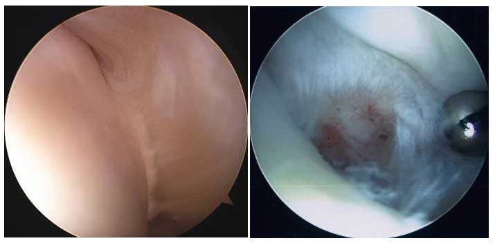 Normal vs Torn Rotator Cuff