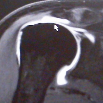 MRI of massive rotator cuff tear