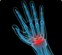 Wrist of a skeleton where red indicates a specific pain area