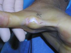 A large cyst peaking out the external skin of a patient
