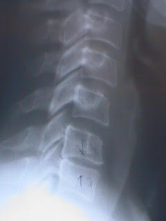 Cervical spine and neck arthritis