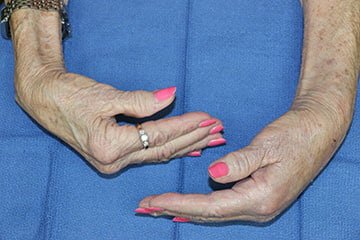 arthritis in a woman's wrist
