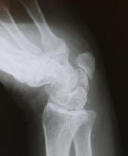 x-ray of pisotriquetral