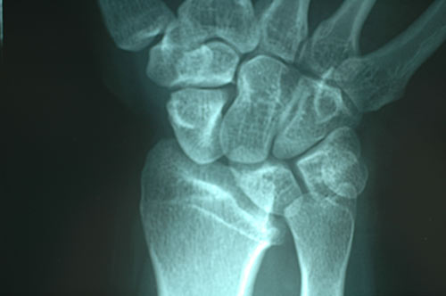 ulnocarpal that causes ulnar wrist pain