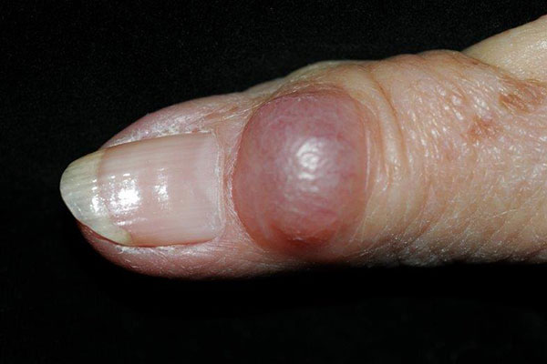 thumb with large ganglion cyst - top view
